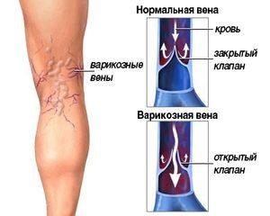 Venus insuficiență a simptomelor și tratamentului extremităților inferioare