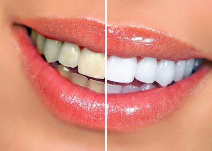 Kiválasztása a legjobb fehérítő fogkrém elfogulatlan tanácsot