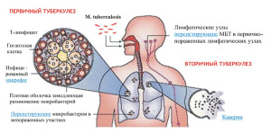 Tipuri de tuberculoză