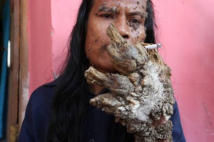 В Індонезії помер відомий на весь світ діда косвара або людина-дерево