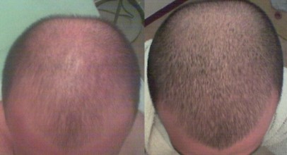 Випадання волосся у чоловіків причини і лікування, фітнес-спільнота, портал любителів фітнесу, велнес,