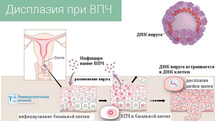 Вірус папіломи людини (папіломавірус) - університетська клініка Харків