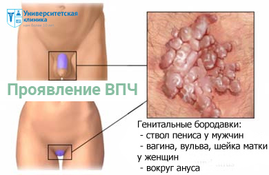 Papilomavirus uman (papilomavirus) - clinica universitară din St. Petersburg