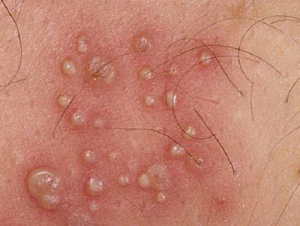 Herpesul afectează dezvoltarea papilomilor și vice versa cum se poate distinge papilomatoza de infecția cu herpes
