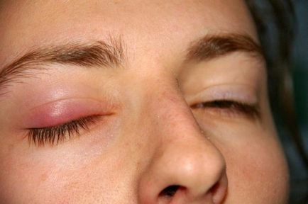 A szemhéj felső szemének ödéma okai és kezelése