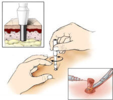 Luarea unui material patologic pentru histologie