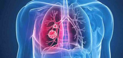 Chimioterapia pentru eficacitatea cancerului pulmonar, medicamente, nutriție
