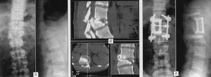 Metode chirurgicale în tratamentul complex al fracturilor coloanei vertebrale toracice și lombare
