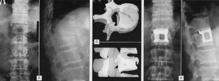 Metode chirurgicale în tratamentul complex al fracturilor coloanei vertebrale toracice și lombare