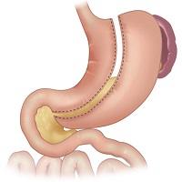 Simptome și tratament al gastritei biliare
