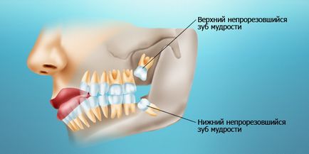 Dinții de înțelepciune - câte sunt tăiați și cum să eliminați durerea