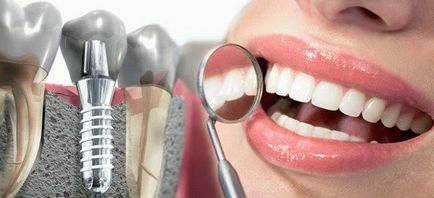 Implanturile dentare la cheie, revizuirea ofertelor clinicilor din Moscova