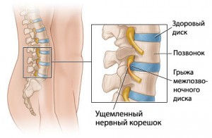 10 Exerciții pentru încărcarea cu o hernie a coloanei vertebrale a zonei lombare și toracice