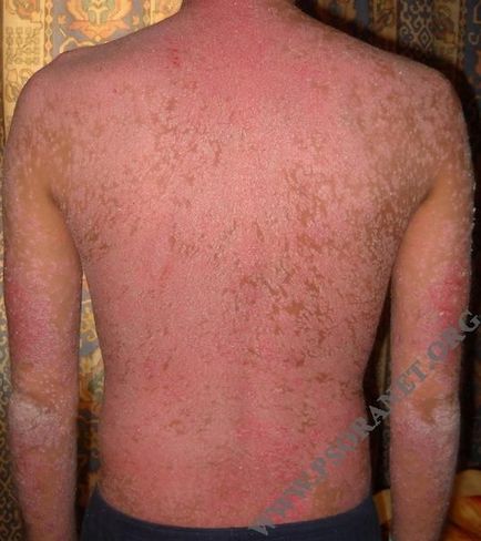 19 nap egy évben: Safaga, Egyiptom - Let psoriasis kezeljük