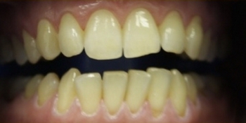 Адгезивний мостовидний протез Житомир ціни, відгуки, адреси стоматології