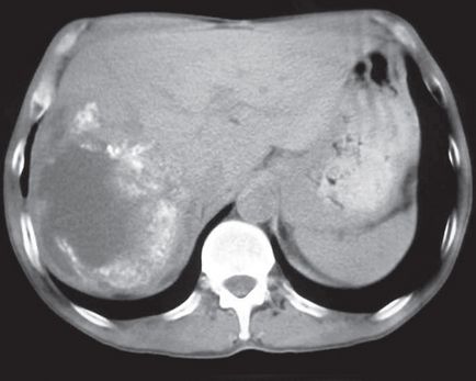 Альвеококкоз печінки - ультразвукова діагностика та комп'ютерна томографія - курзанцева про