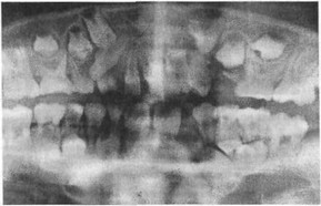 Alveoláris csont - a fő komponens a periodontális szövetek