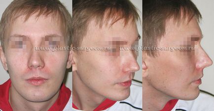 Andrishchev andrey Ruslanovich - posibilitatea utilizării implanturilor faciale individuale