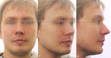 Andrishchev andrey Ruslanovich - posibilitatea utilizării implanturilor faciale individuale