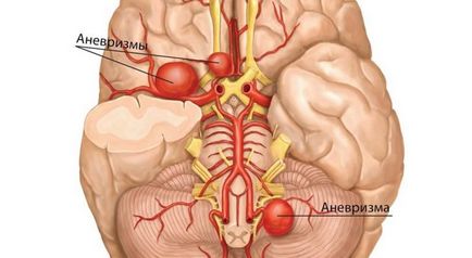 Аневризма судин головного мозку симптоми, лікування, операції при аневризмі