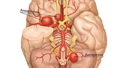 Agyi aneurizmák tünetek, kezelés, működés aneurizma