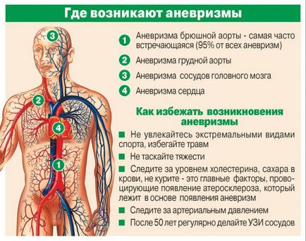 Agyi aneurizmák tünetek, kezelés, működés aneurizma