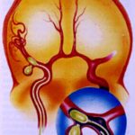Аневризма судин головного мозку симптоми, лікування, операції при аневризмі