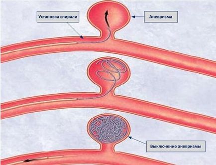 Аневризма судин головного мозку симптоми, лікування, операції при аневризмі