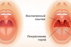 Angina nélkül mirigyek (kb angina) Angina nélkül mirigyek