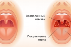 Ангіна без гланд