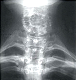 Anomalii în dezvoltarea coloanei vertebrale - cauze, simptome, diagnostic și tratament