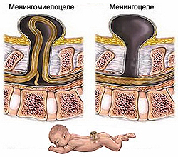 Anomalii în dezvoltarea coloanei vertebrale - cauze, simptome, diagnostic și tratament