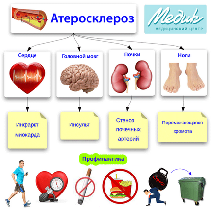 Ateroscleroza, simptome, tratament