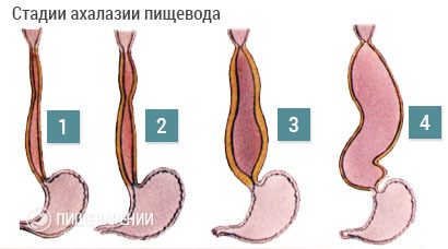 Humán nyelőcső achalasia, mi ez