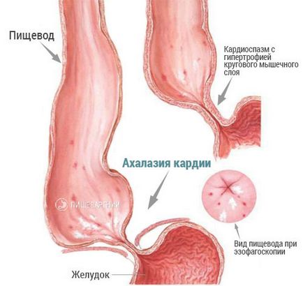 Cardia Akhalasia a esofagului uman, ce este?