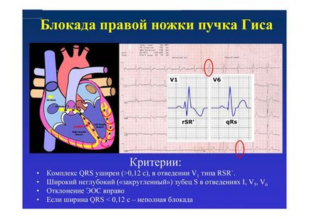 Blocarea picioarelor pachetului de gyus în inimă - incomplet, drept și stâng, complet, parțial, simptome, tratament