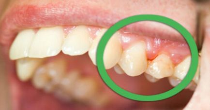 Durerea gingiei în apropierea cauzelor și tratamentului dintelui