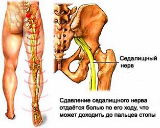 Leg болка - ишиас cimptomy заболяване, лечение на болки в крака