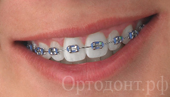 Braces mester kezelési