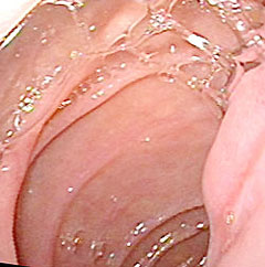 Bulbit duodenum