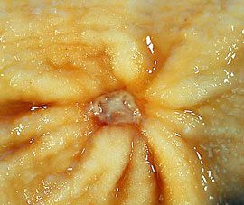 Bulbit duodenum