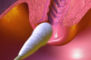 Eroziunea gâtului unui uter în timpul sarcinii este periculoasă