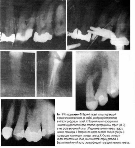 Reading az X-ray endodoncia