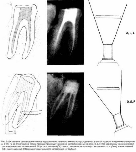 Citirea radiografiilor în endodonție