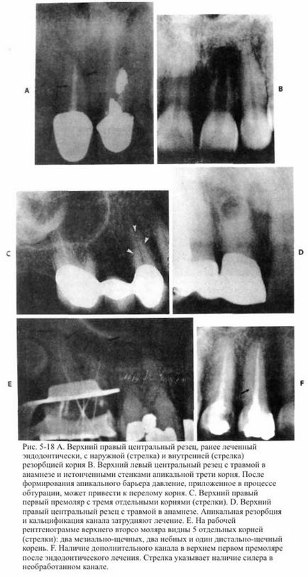 Citirea radiografiilor în endodonție