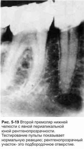 Reading az X-ray endodoncia