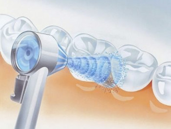 Ce este curățarea dinților cu flux de aer și feedback?