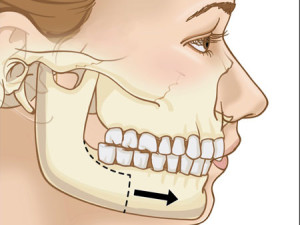 Deformările și defectele cauzate de maxilarul superior și inferior, simptome