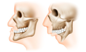 Deformációkat és hibák a felső és alsó állkapocs okoz, a tünetek