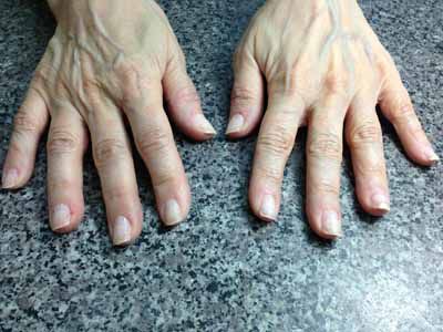Деформація нігтів на руках і ногах причини і лікування